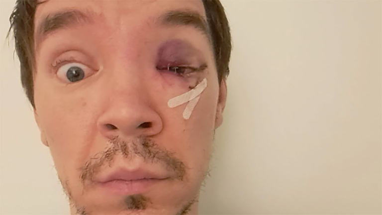 Man met blauw oog en pleisters op zijn rechterwang kijkt recht in de camera.