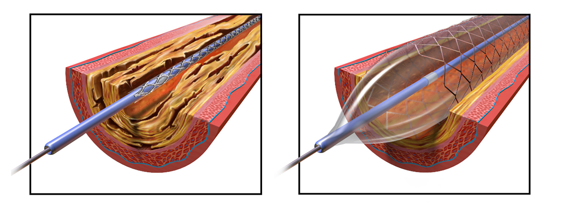 Illustratie van een stentimplantatieprocedure in een ader, met links een stent die de ader openhoudt en rechts een opgeblazen ballonkatheter die de stent plaatst.